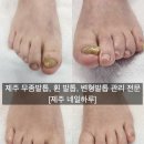문제성 손발톱 전문관리 케어톱톱