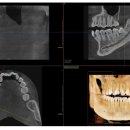 UR(원주시)-[신지정로]-하-6 | 원주 무실동 임플란트 치과/서울플란트치과/19년차...전문의 책임진료..매복 사랑니 발치 후기/리뷰/안내