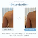 [한달만에 눈바디-10kg] 예신관리 / 팔뚝지방흡입 효과 승모근보톡스 효과 / 대구예신관리 / 대구웨딩케어