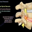 척추관협착증(Spinal Canal Stenosis) 이미지