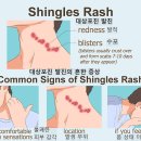 음식과 질환 - 대상포진 이미지