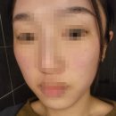 튠플러스 | 압구정 튠페이스 인모드 튠모드 웨딩관리 리프팅 비포 에프터 2차 후기
