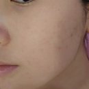 화정역 [다솜 에스테틱] 여드름 압출 관리 후기