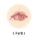 구순염(Cheilitis) 이미지