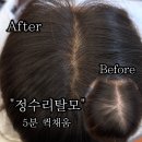 채움메디칼 | 운정,일산,김포,인천,덕이동 에서 모두 찾아오는 가을쌤 퀵채움 정수리탈모커버 완벽해결!