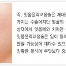 -> 돌출입/돌출입교정으로 아름다운 입매 만들기 ★ 이미지