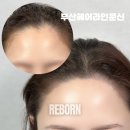 선헤어라인 이미지