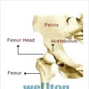 [고관절] 대퇴골두무혈성괴사 AVN란? 이미지