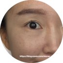 제주도피부과 기미 흑자치료 남재희삼성피부과의원 후기