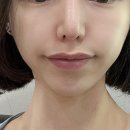 강남-200 | 강남 울트라콜200 피부과에서 받고 온 찐 후기와 가격 공유해요