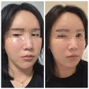 스컬짐 | 대구칠곡피부과 추천 통증없는 스컬피오 리프팅레이저 효과 내돈내산 후기