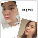 항세상외과의원 | [강남코수술잘하는곳][신상성형외과]회복이 빨랐던 코수술 3주차 경과 후기&#39;◡&#39;✿