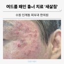 [수원인계동 피부과/수원인계동 한의원] 새살침으로 여드름 패인 흉터 치료받은 솔직 후기!