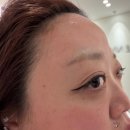 세모안경 | 서울 시청역 피부과 이마필러 내돈내산 후기_통증 부작용 관리 방법