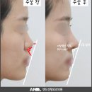 전통선술 | 비순각교정 인중코 복코 코성형 후기