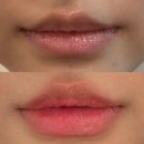 멍스타일 | 부산 입술필러 벨로테로 1cc 연산동 피부과 붓기 멍 후기