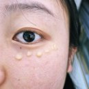 ㈜제일 | 엑소좀아이크림 EXOMEREG 아이론샷 눈밑홈케어 솔직후기