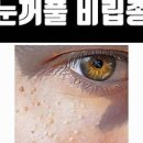 눈꺼풀 눈밑 비립종 원인, 눈 비립종 제거 후 관리. 이미지