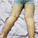 듀피에 - 홍천군 | 6살 아토피 듀피젠트 2년차 후기 (고대안암 유영교수님)