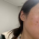 남디 | 창원 편평사마귀 제거 후기 얼굴 목 한판 제거 아무데서나 하면 안돼요