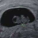 마이더스산부인과의원 | [임신일기] 5주차 ~13주차 (임신초기) 입덧, 갑상선저하증, 자궁근종 이슈 덩어리 임산부,,