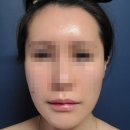 티타늄 리프팅 내돈내산 듀얼 티타늄 리프팅 80KJ 2회차 시술 후기 및 유지 기간