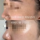 이브케어 인천지점 | 검단 청라 여름철 피부관리 '비비드엘 인천점' 기미 잡티 케어 후기
