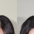 아이니드투어 | [내돈내산][서산 니드로우] SMP 두피문신 솔직 후기｜결혼 전 관리, 정수리 고민 해결