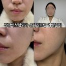 강남역성형외과 온다리프팅 리얼 후기