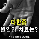 땀 때문에 불편하다, '다한증 원인' 및 치료는?? 이미지