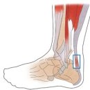 ＜무리한 운동으로 인한 아킬레스건 통증＞아킬레스건 통증 -연세사랑병원-﻿ 이미지