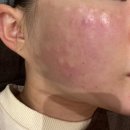 하이미의원 | 신사 하이미의원에서 물광주사 5cc 맞고 건조함 잡은 찐 후기