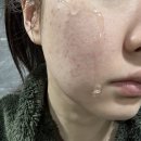 링크스팟 | 올리브영 아누아 트러블 세트(세럼/스팟크림) 솔직 내돈내산 후기! +할인 비밀링크 남겨놨어요 🫶🏻😊