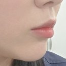 바노바기의원 | 부산 바노바기의원 입술필러 후기