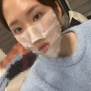 멍스타일 | [쌍수일지] ㅇㅁㄷ자연유착 쌍수1~5일차 후기｜붓기·멍·통증 리얼 변화(+회복기간)