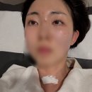 세브란스피부과의원 | 갑상선전절제 2개월차, 흉터 관리법 레이저 후기, 메피폼꿀팁