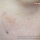 56 | 기미도감 자색 당근 세럼 56일 째! 마지막 후기 [내돈내산/기미잡티제거]