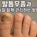 [단기강좌] 바른 걸음 발 건강 | 발톱무좀과 발 각질 함께 관리하는 방법