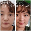 얼굴지방분해주사 얼굴갸름해지는법 2회차 후기 !!