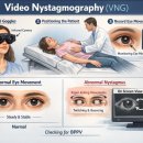 어지러움과 이석증, 어떻게 진단할까? 비디오 안진 검사(VNG) 진행 후기