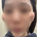 예예의원 | 윤곽주사 맛집 | 페이스하프컷 광대 이중턱 얼굴지방분해주사 일주일차 후기