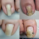 치유본의원 | 일산 파주 내성발톱 발톱무좀 실손보험까지 되는 치유본한의원의원 일산점 무좀 치료 만족 후기