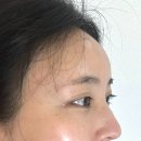 아띠댕댕 | 광주 국산 뉴라미스 이마필러 6cc 3일차 붓기 후기 (사진많음) 눈이 무거워요..