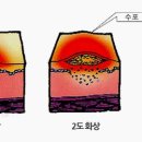 사고시 응급대처법 이미지