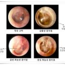 중이염 증상 성인 소아 중이염 원인 이미지