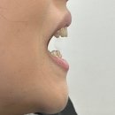 마리아쥬니어치과의원 | 용인 성인교정 용인쥬니어치과의원, 마의 아래 앞니 위로 올리기