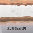 씨오투 환경 | 대치역청담역피부과 주근깨, 기미, 잡티, 검버섯, 피코레이저 피코토닝 정말 효과 있나요?
