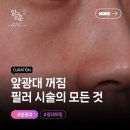 앞광대 꺼짐 문제가 심했던 여성 환자 필러 시술 후기