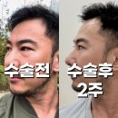 유주왕외과의원 | 남자 눈밑지방재배치 내돈내산 리얼후기