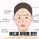 여드름 부위별 원인, 여드름 위치별 건강 이미지